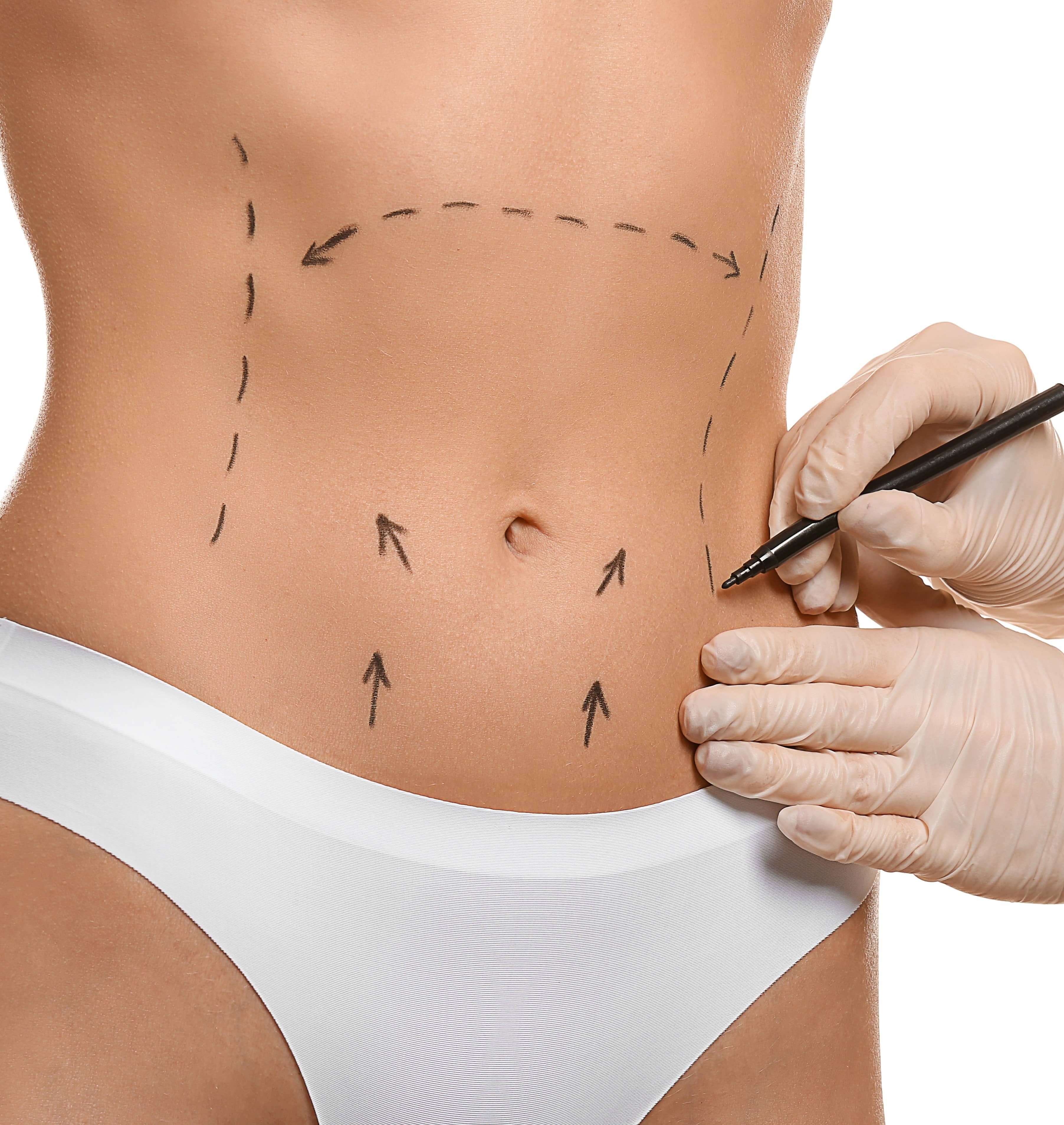 The Difference Between a Panniculectomy and a Tummy Tuck